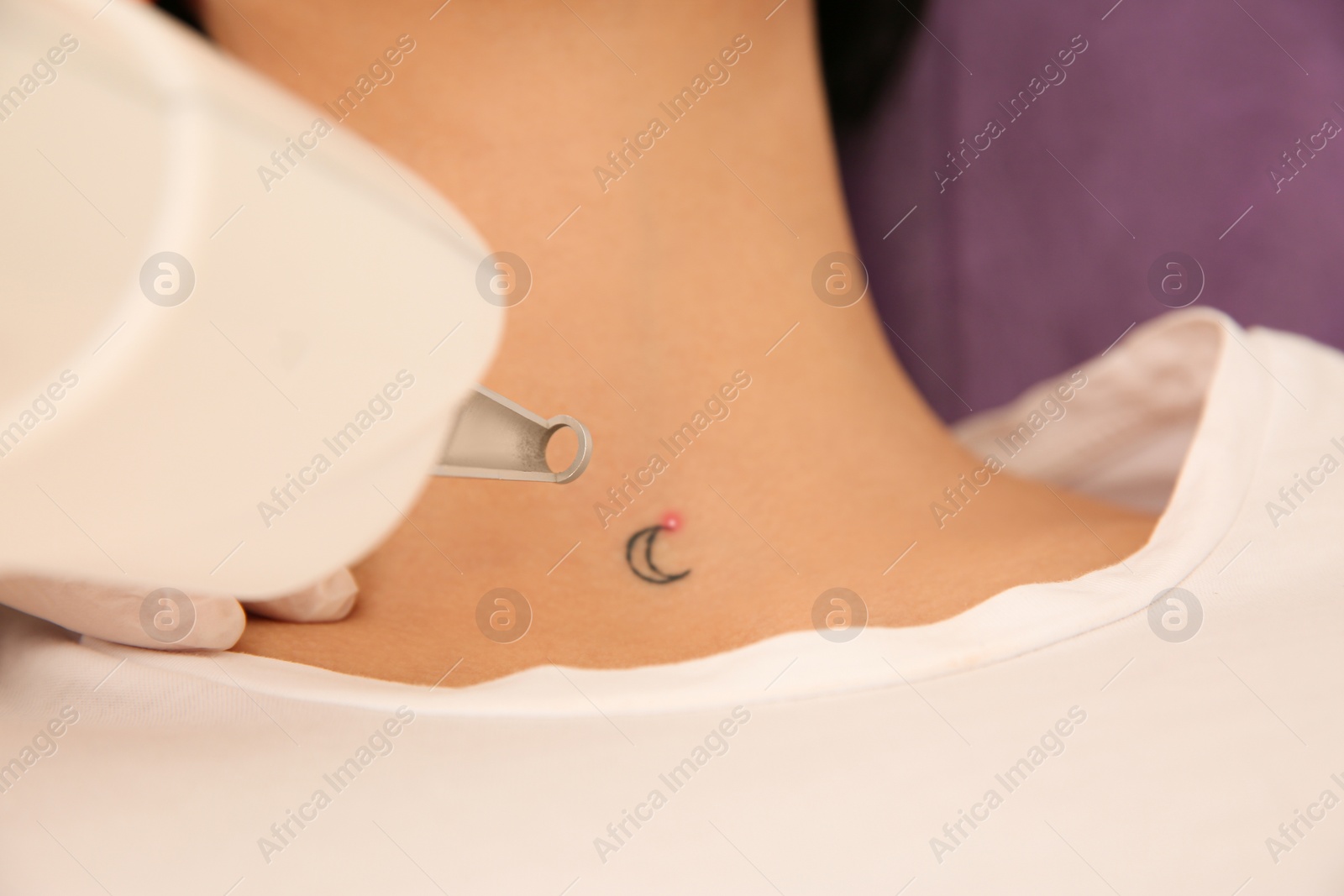 Photo of Young woman undergoing laser tattoo removal procedure in salon, above view