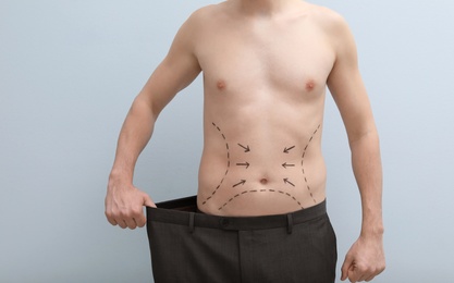 Young man with marks on belly for cosmetic surgery operation on light background