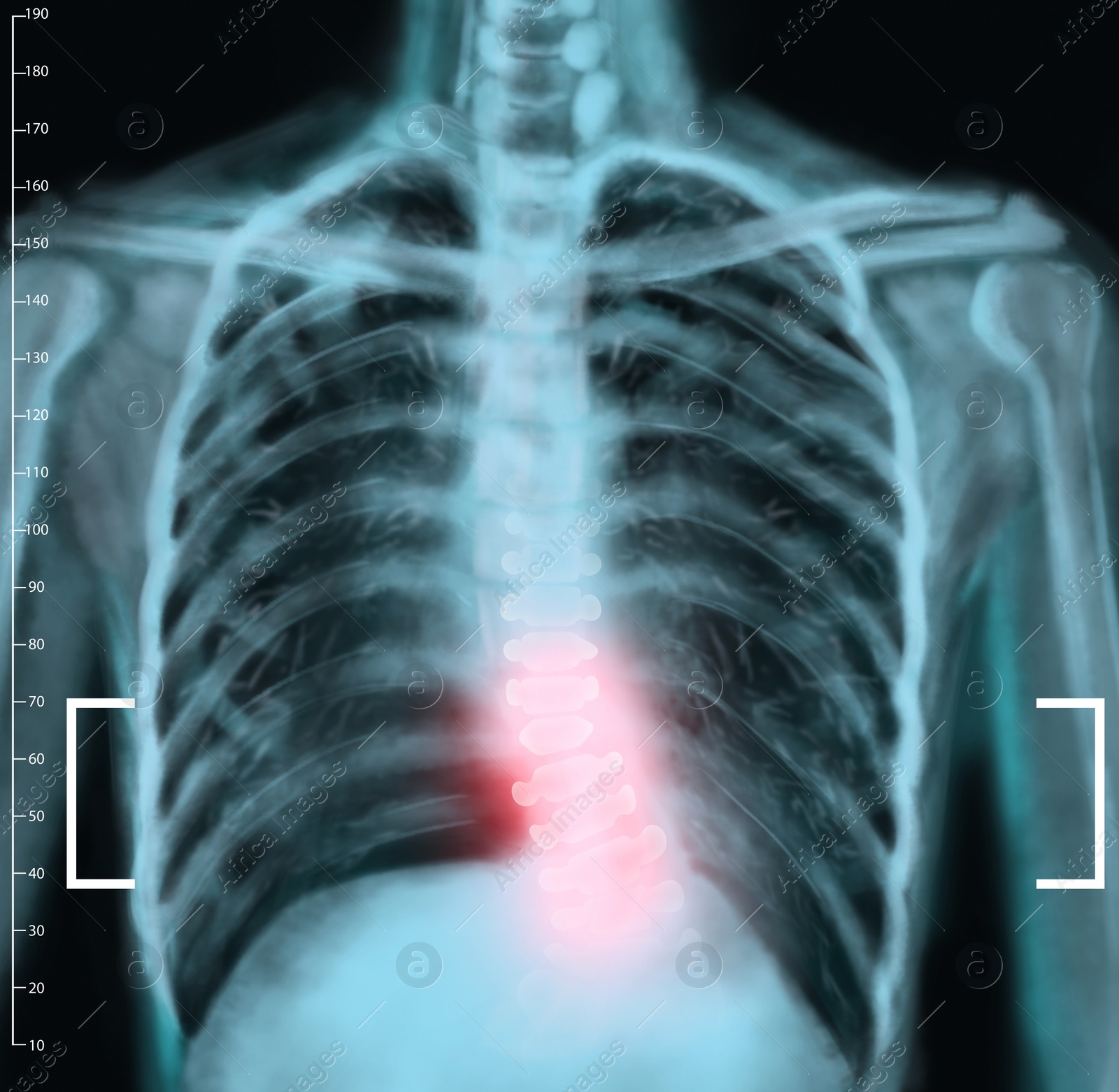 Illustration of X-ray of human spine showing curvature. Patient suffering from scoliosis