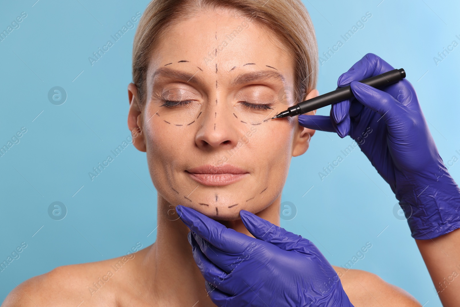 Photo of Doctor with marker preparing patient for cosmetic surgery operation on light blue background, closeup