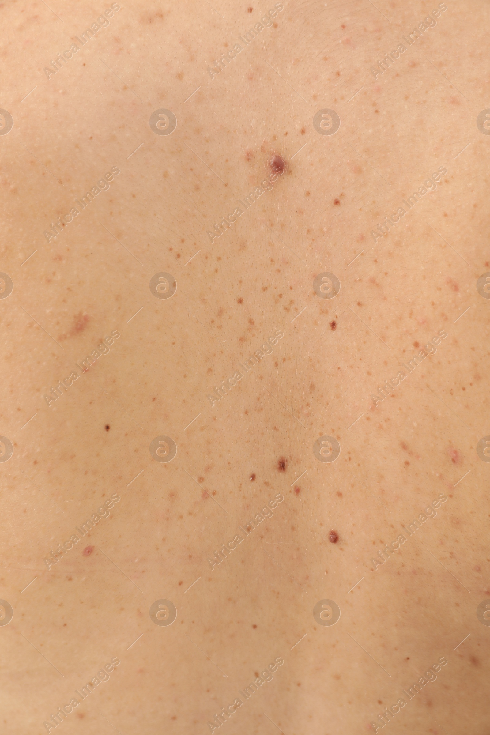 Photo of Closeup of woman's body with birthmarks as background