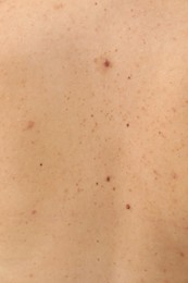 Closeup of woman's body with birthmarks as background