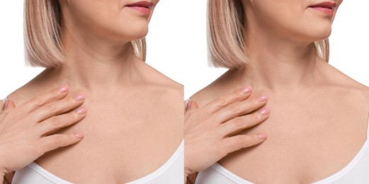 Image of Collage with photos of woman before and after cosmetic procedure on white background, closeup
