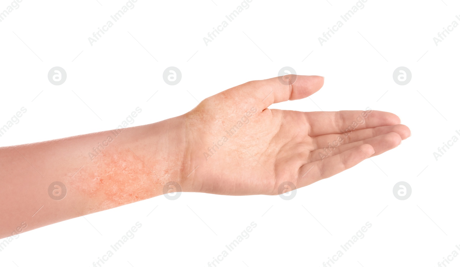 Image of Woman showing hand with dry skin on white background, closeup