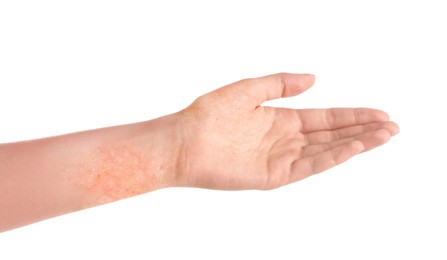 Image of Woman showing hand with dry skin on white background, closeup