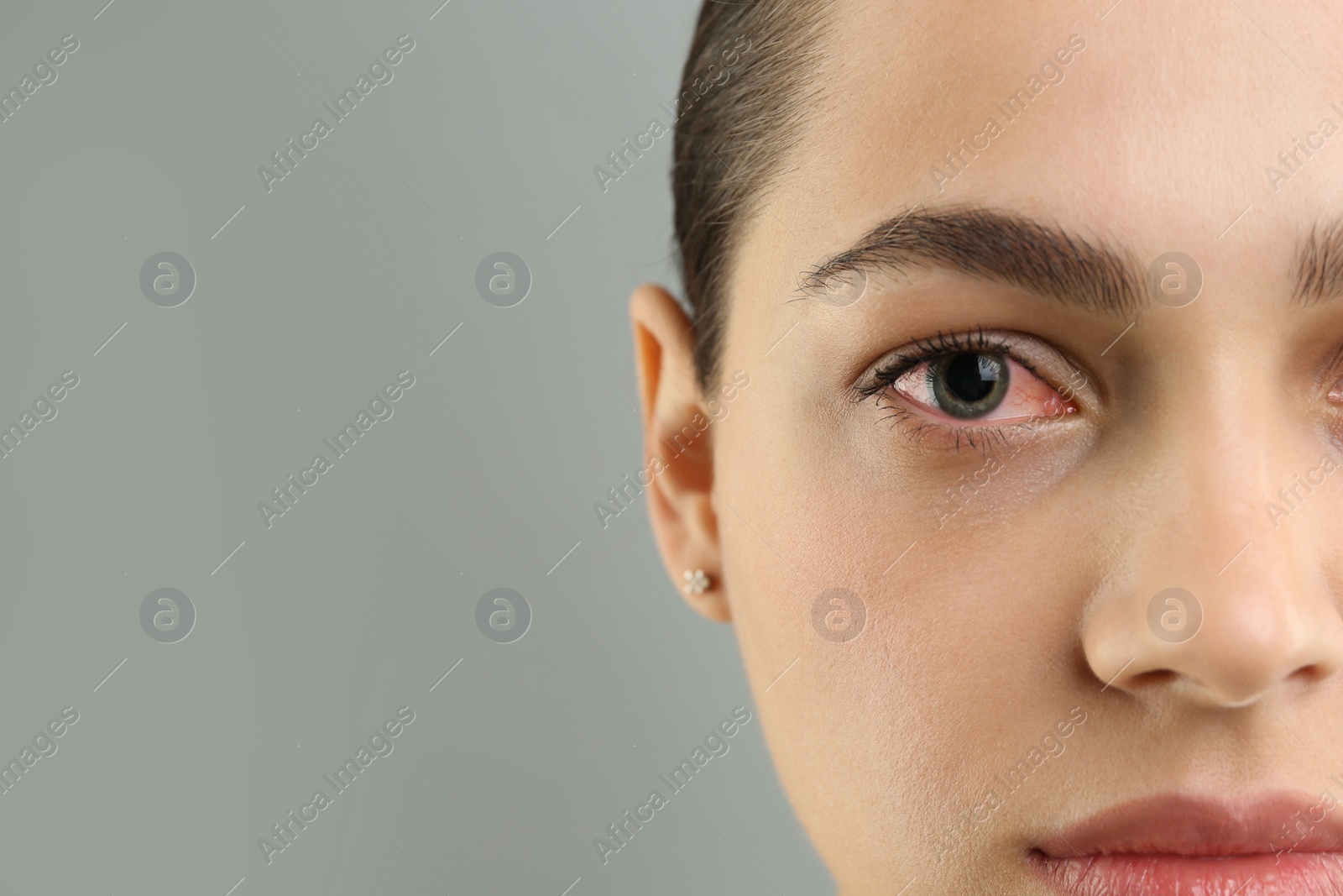 Image of Woman with red eye suffering from conjunctivitis on grey background, closeup
