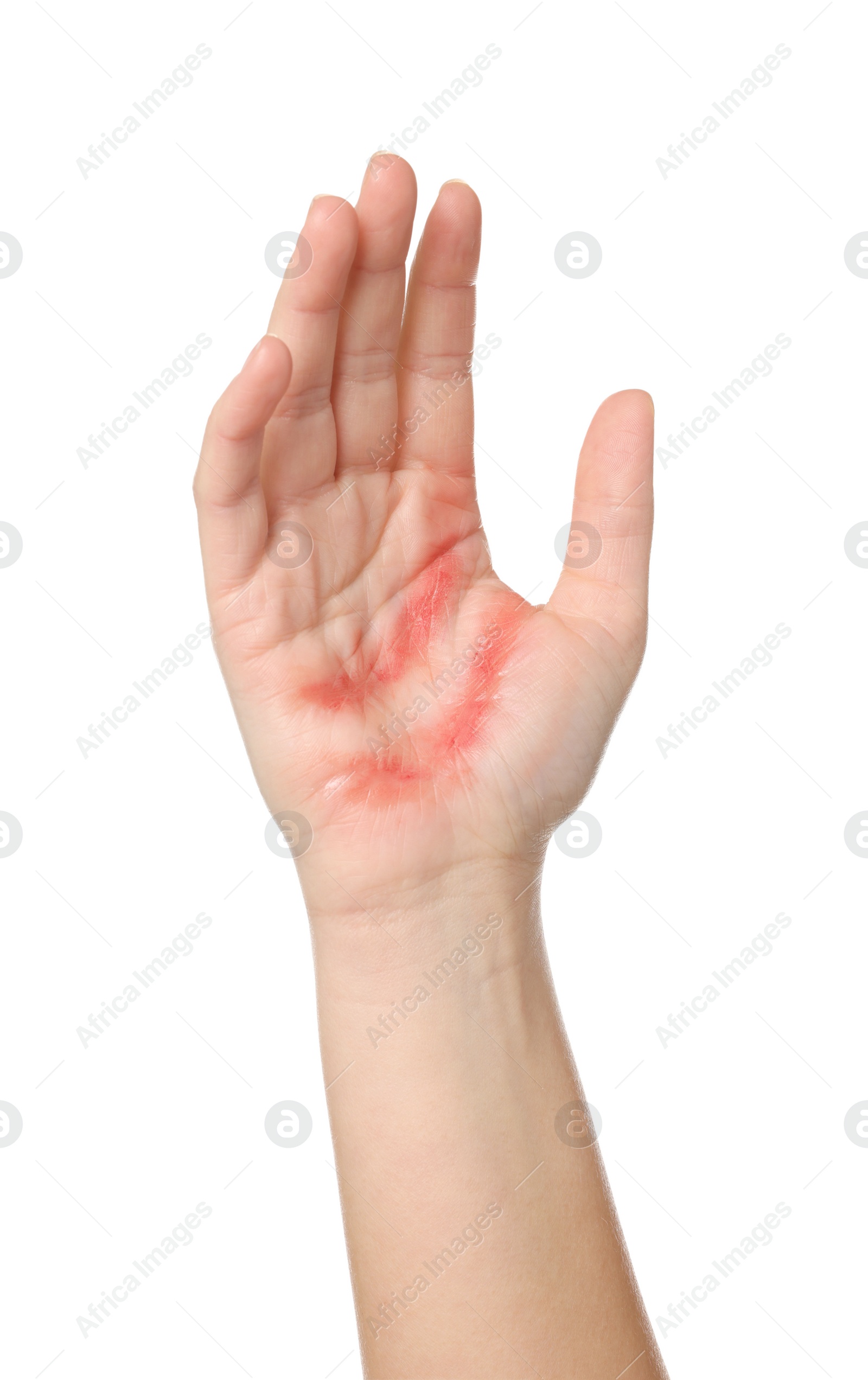 Photo of Woman with burned hand on white background, closeup