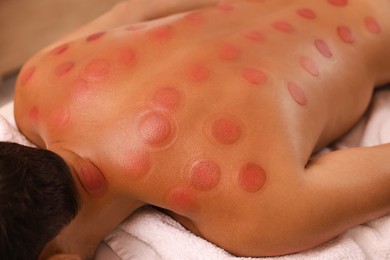 Closeup view of man after cupping therapy indoors