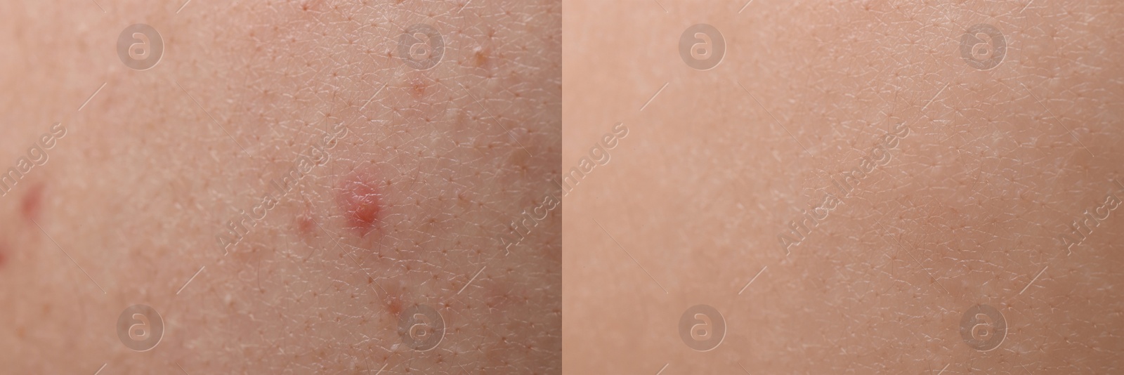 Image of Collage with photos of person suffering from acne before and after treatment, closeup. Banner design showing affected and healthy skin