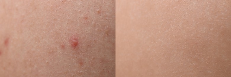 Image of Collage with photos of person suffering from acne before and after treatment, closeup. Banner design showing affected and healthy skin