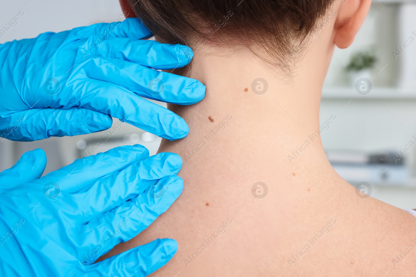 Photo of Dermatologist examining patient's birthmark in clinic, closeup