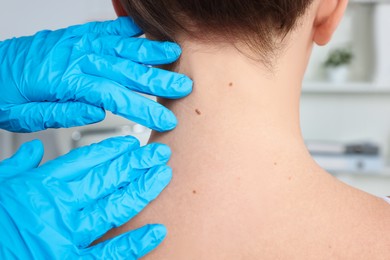 Dermatologist examining patient's birthmark in clinic, closeup
