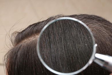 Photo of Closeup of woman with dandruff in her hair, view through magnifying glass