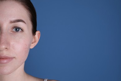 Young woman with acne problem on blue background. Space for text