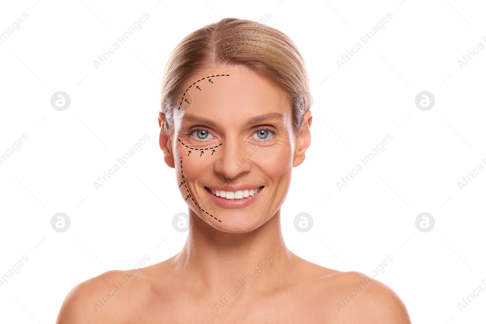 Image of Woman with markings for cosmetic surgery on her face against white background