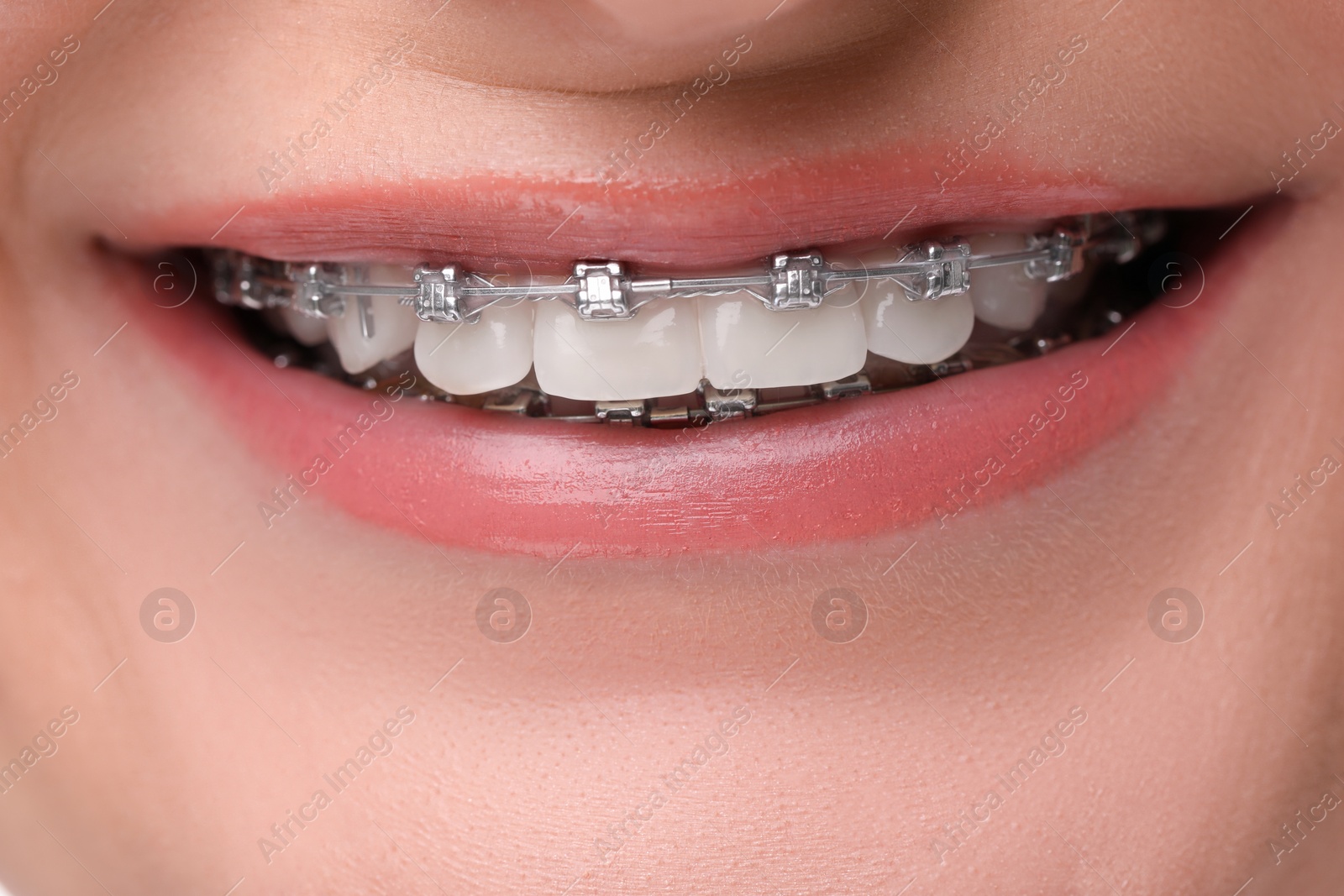 Photo of Smiling woman with dental braces, closeup view