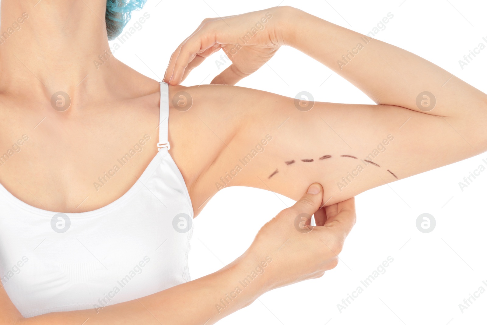 Photo of Woman with marks on arm for cosmetic surgery operation against white background, closeup