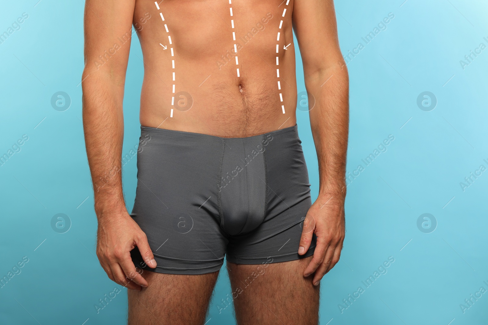 Image of Man with markings for cosmetic surgery on his abdomen against light blue background, closeup