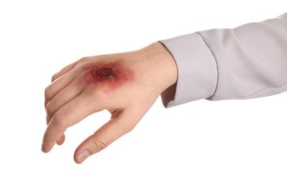 Photo of Woman with burned hand on white background, closeup