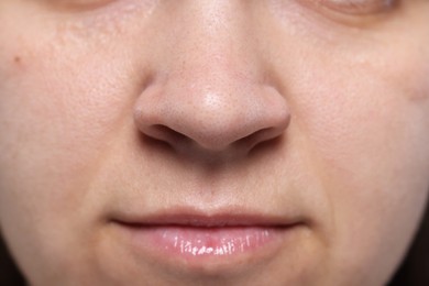 Closeup view of woman with comedones on her nose