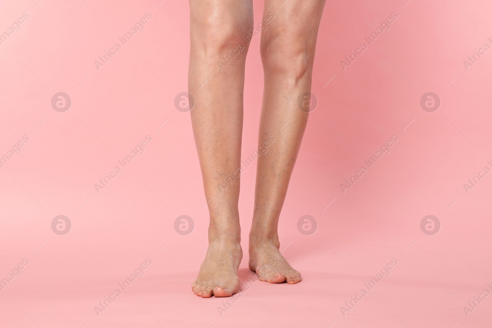 Photo of Closeup view of woman with varicose veins on pink background