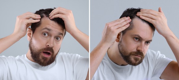 Man showing hair before and after dandruff treatment on grey background, collage