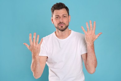 Photo of Man with rash suffering from monkeypox virus on light blue background