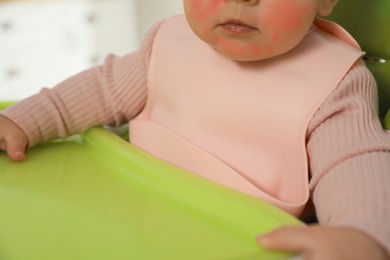 Image of Cute little baby with allergic redness wearing bib in highchair indoors, closeup