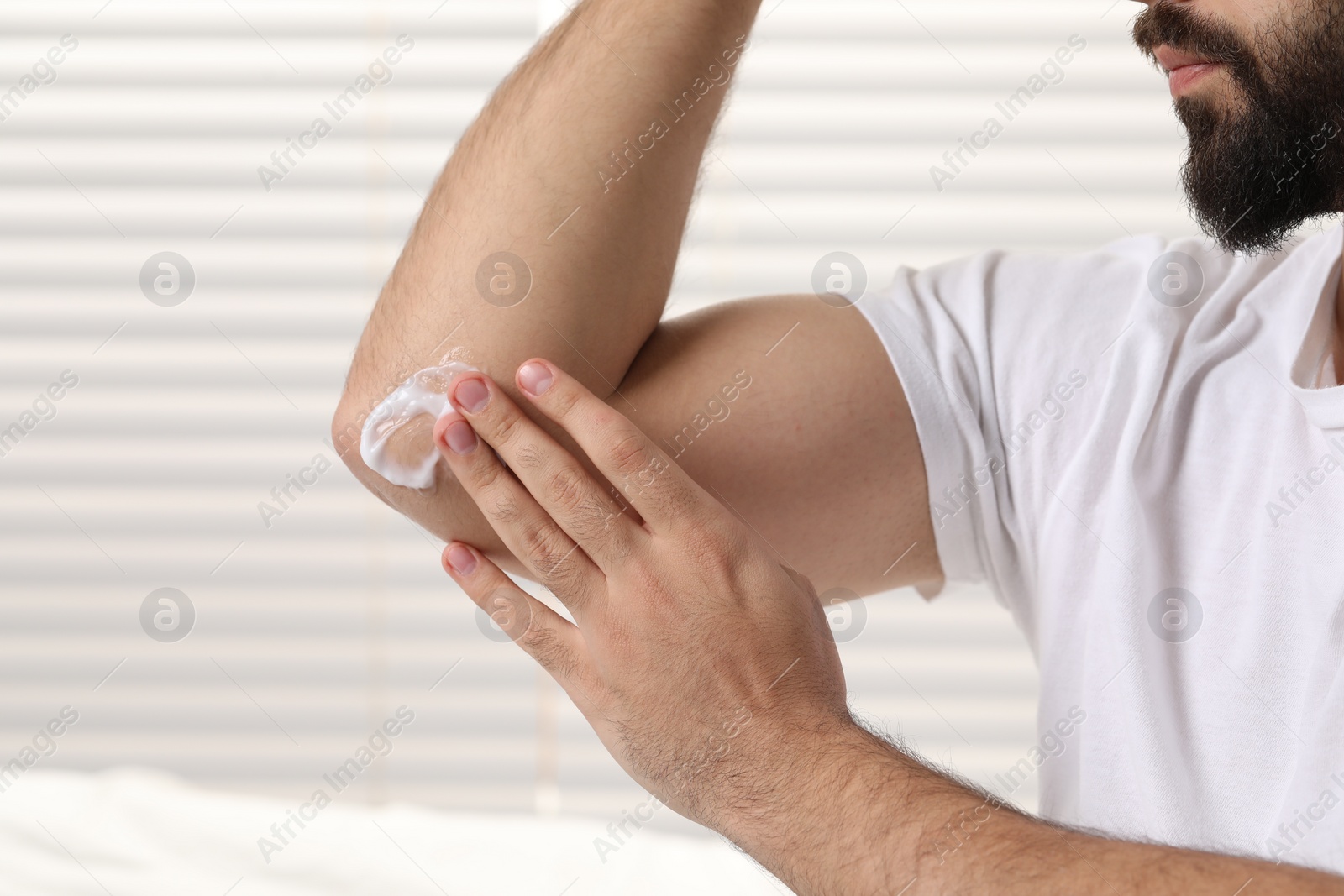 Photo of Man with dry skin applying cream onto his elbow on light background, closeup