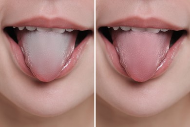 Image of Woman showing her tongue before and after cleaning procedure, closeup. Tongue coated with plaque on one side and healthy on other, collage