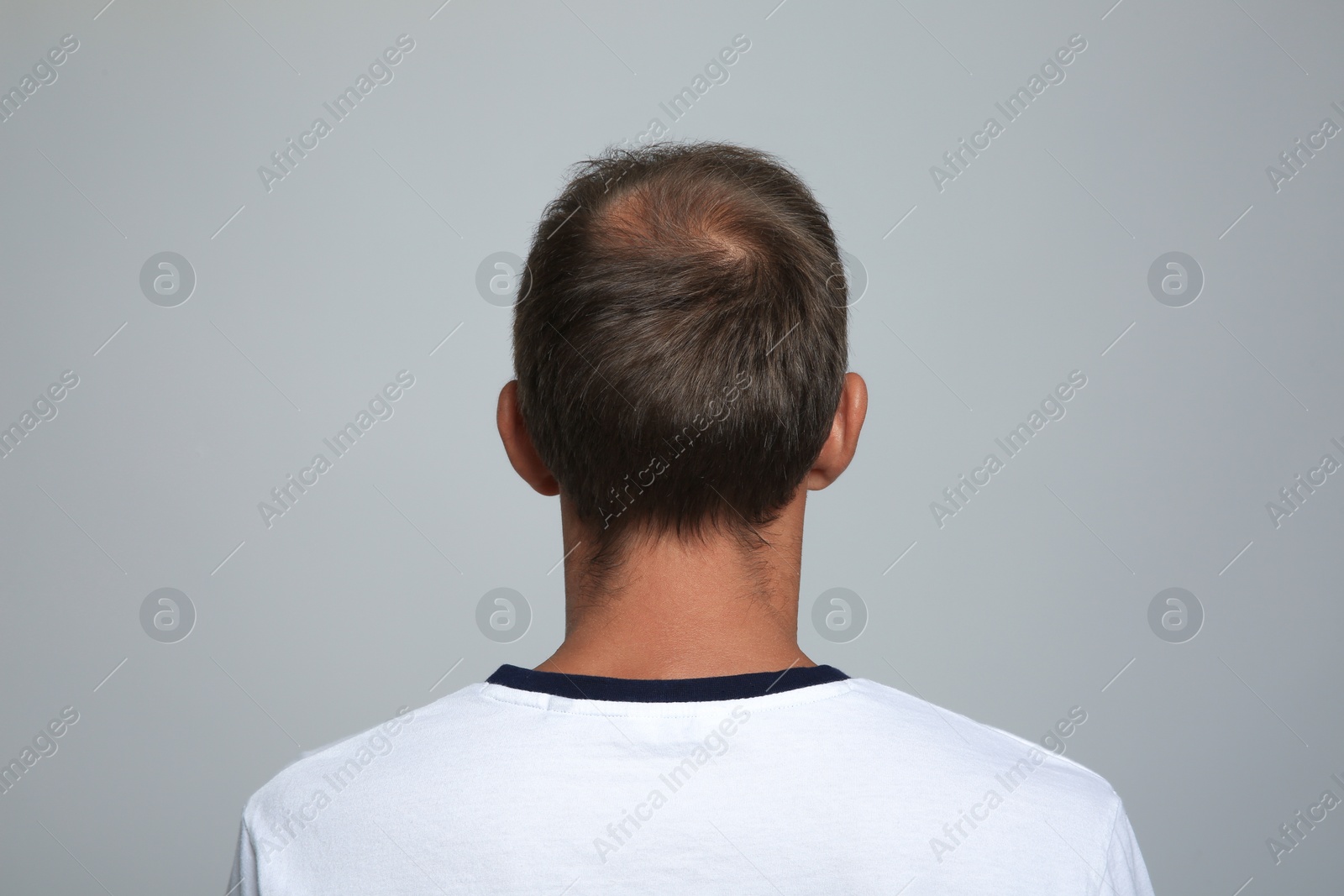 Photo of Man with hair loss problem on light grey background, back view