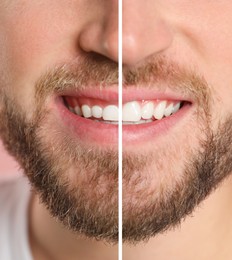 Image of Young man before and after gingivoplasty procedure, closeup