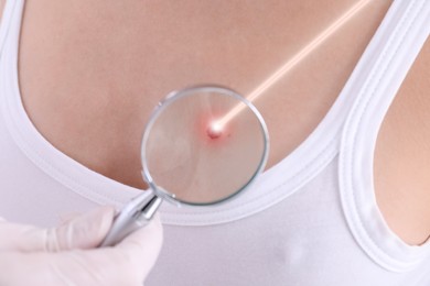 Image of Laser mole removal. Doctor looking at patient's skin through magnifying glass during procedure, closeup