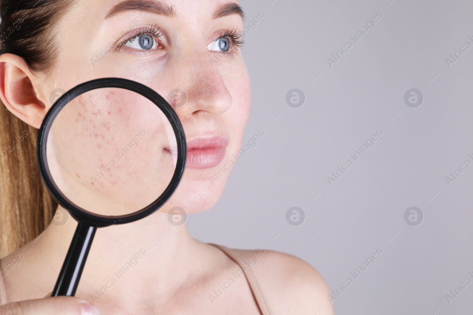 Photo of Young woman with acne problem holding magnifying glass near her skin on light grey background, closeup. Space for text