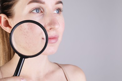 Young woman with acne problem holding magnifying glass near her skin on light grey background, closeup. Space for text