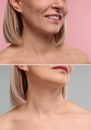 Image of Collage with photos of woman before and after cosmetic procedure on color backgrounds
