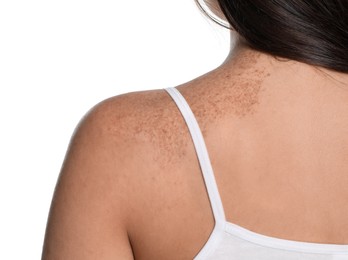 Photo of Closeup of woman`s body with birthmarks on white background, back view