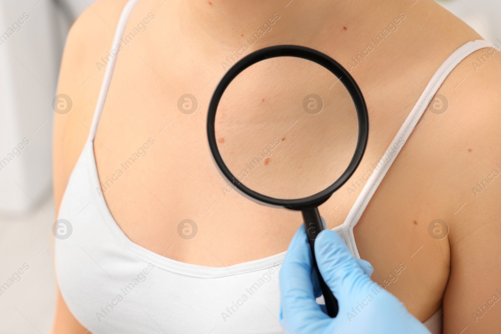 Photo of Dermatologist examining patient's birthmark with magnifying glass indoors, closeup