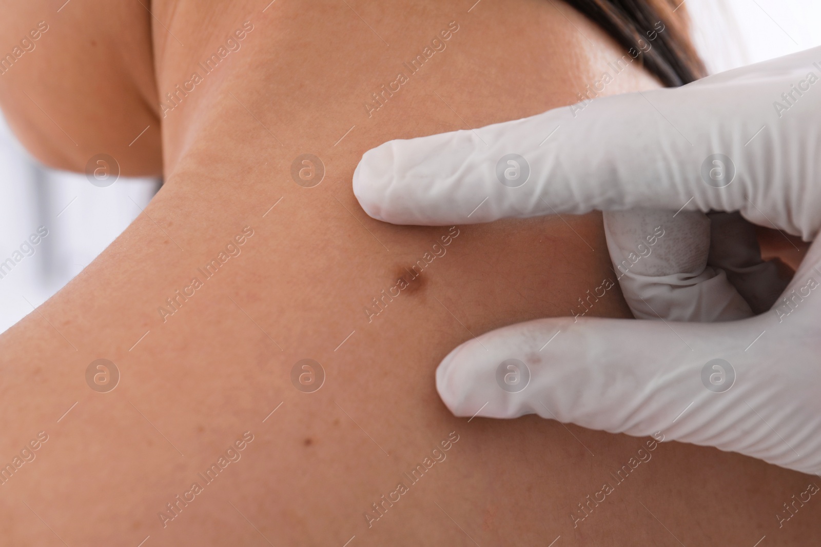 Photo of Dermatologist examining patient in clinic, closeup view