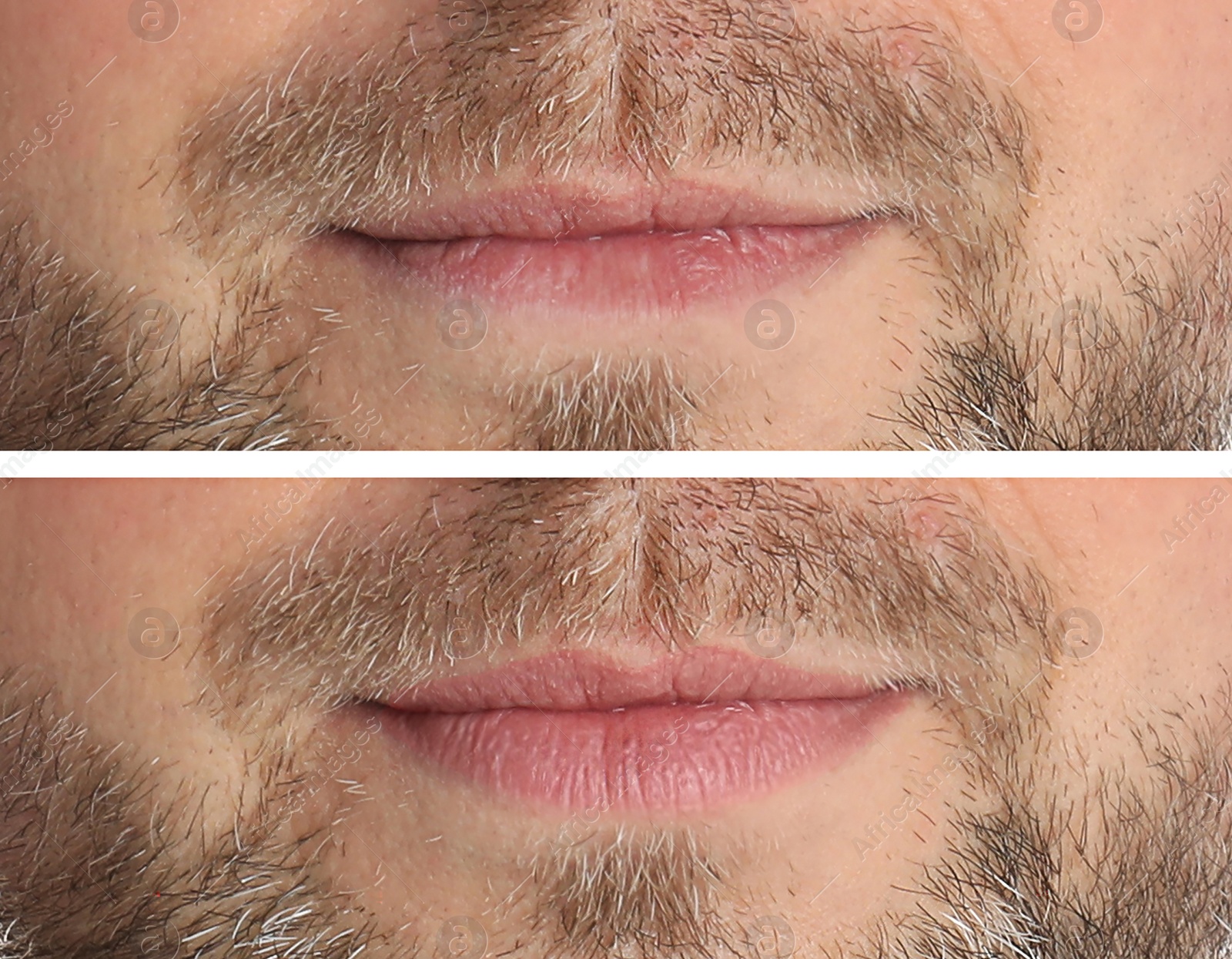 Image of Collage with photos of man before and after lips augmentation, closeup