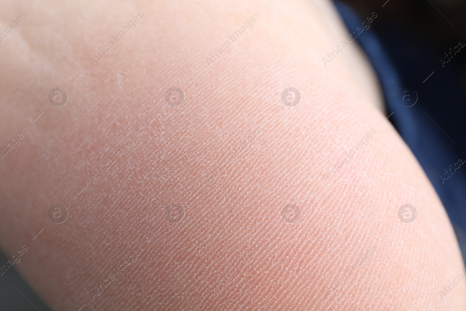 Photo of Woman with dry skin on foot, closeup