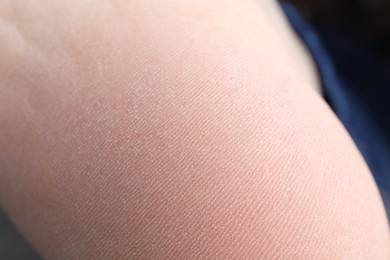 Photo of Woman with dry skin on foot, closeup