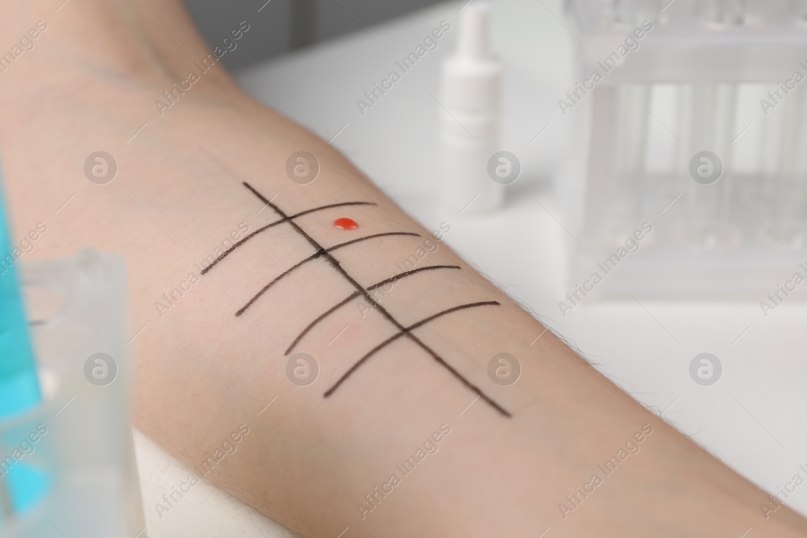 Photo of Patient undergoing skin allergy test at light table in clinic, closeup