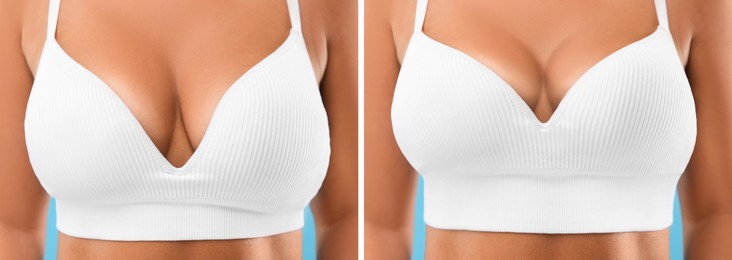 Image of Collage with photos of woman before and after breast-lift surgery, closeup