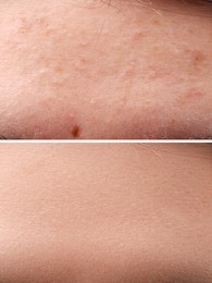 Image of Collage with photos of woman with acne problem before and after treatment, closeup