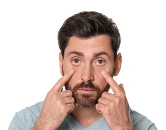 Photo of Man with yellow eyes on white background. Symptom of hepatitis