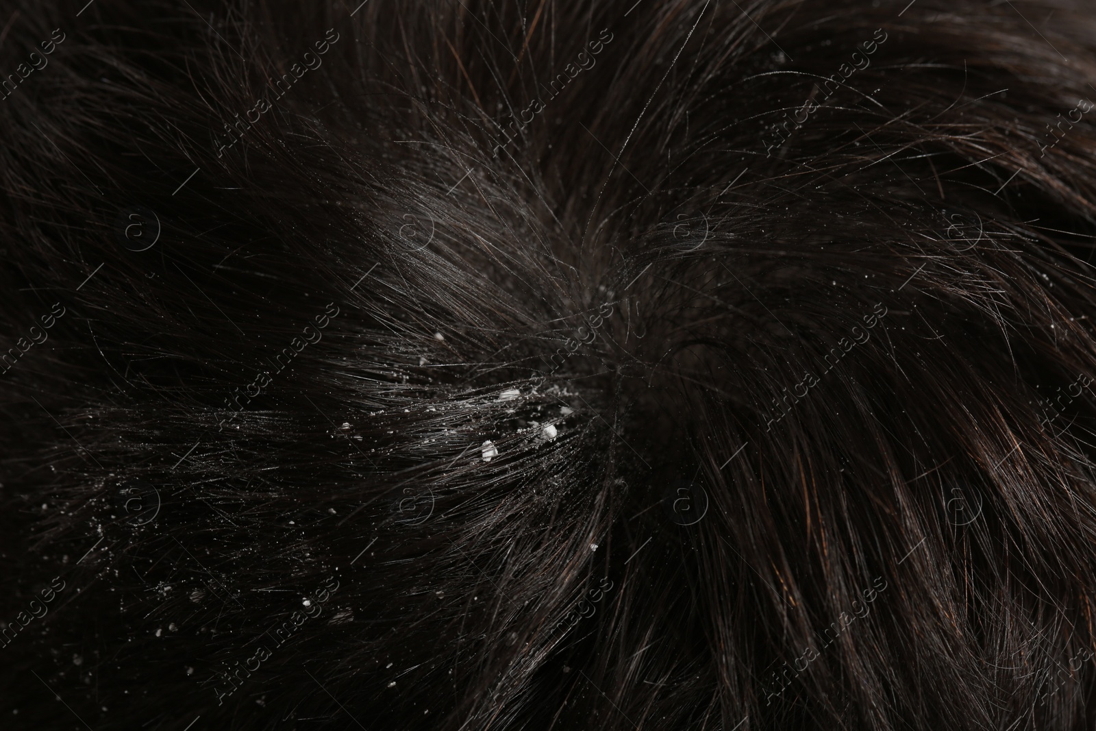 Photo of Man with dandruff in his dark hair, macro view