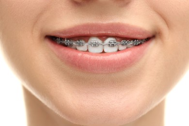 Photo of Smiling woman with dental braces on white background, closeup
