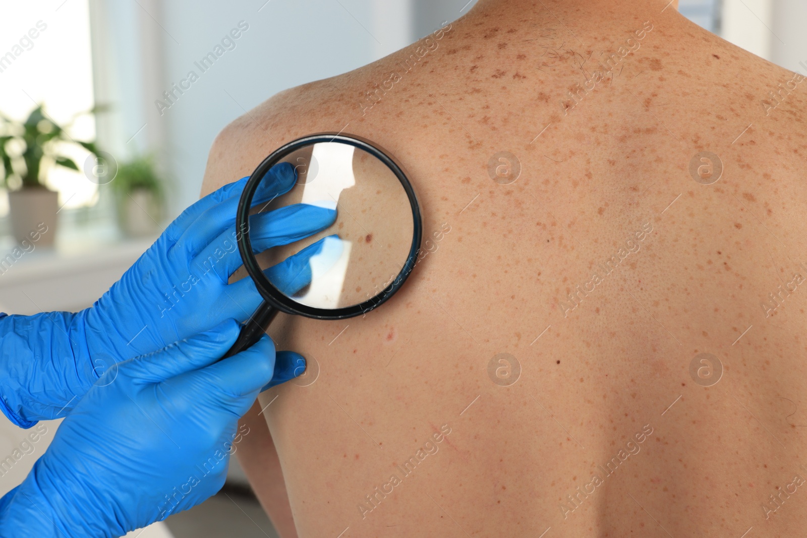 Photo of Dermatologist examining patient's birthmark with magnifying glass in clinic, closeup