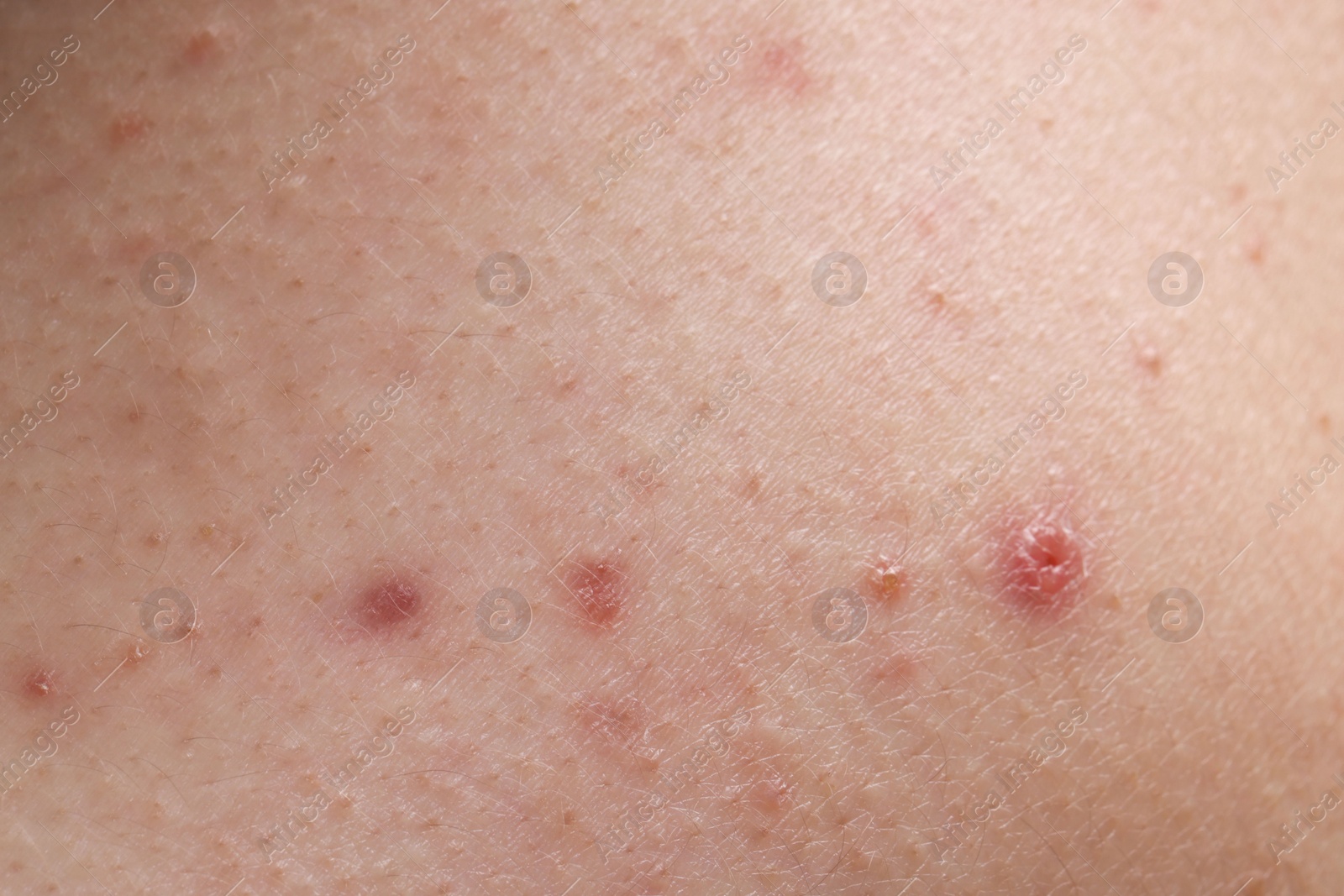 Photo of Young person with acne problem, closeup view of skin